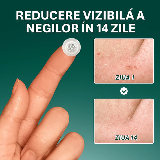 Plasturi pentru eliminarea negilor